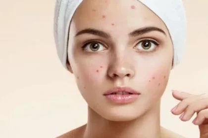 Apply multani mitti on the face like this, acne will disappear