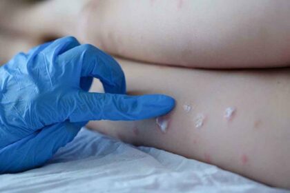 Monkeypox Virus is spreading in India too, know its symptoms and ways to avoid it