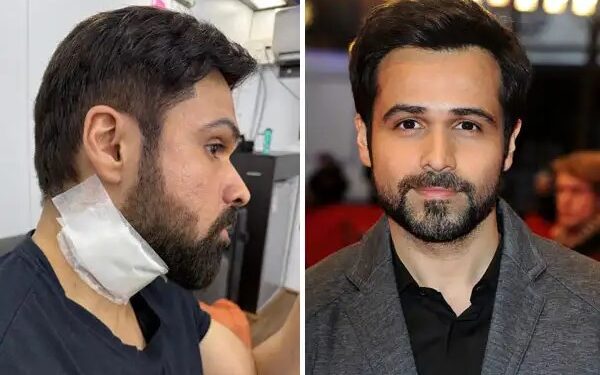 Emraan Hashmi injured during shooting, pictures went viral